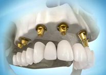 multiple dental implant illustration