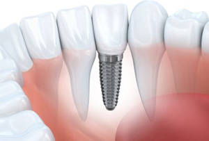 dental implant illustration